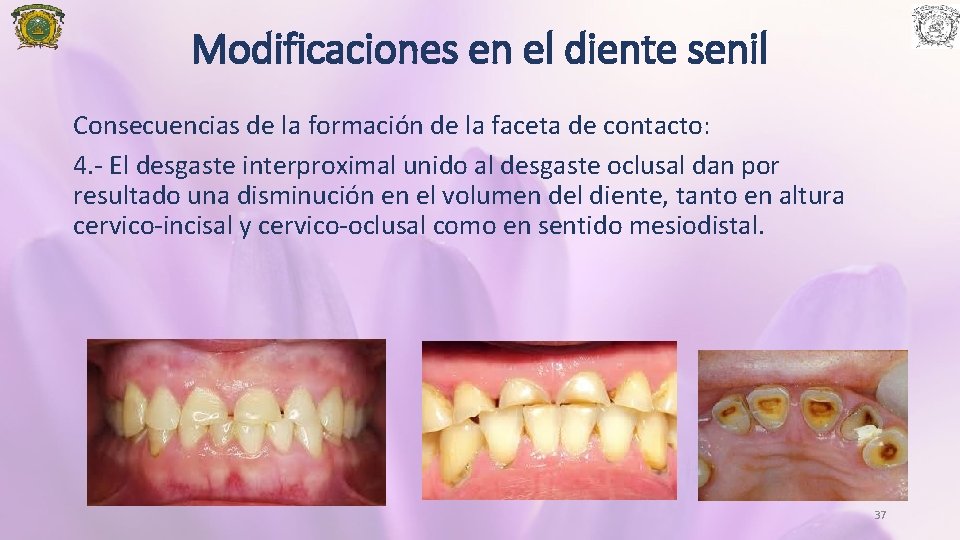 Modificaciones en el diente senil Consecuencias de la formación de la faceta de contacto: