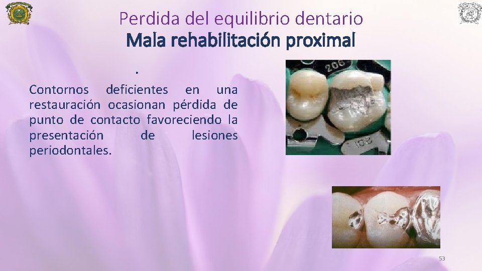 Perdida del equilibrio dentario Mala rehabilitación proximal. Contornos deficientes en una restauración ocasionan pérdida