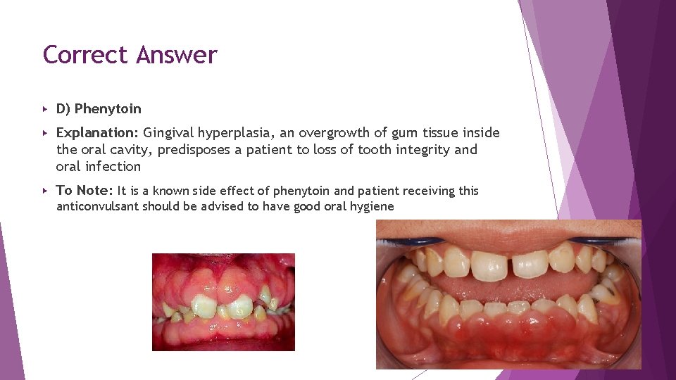 Correct Answer ▶ D) Phenytoin ▶ Explanation: Gingival hyperplasia, an overgrowth of gum tissue Correct Answer ▶ D) Phenytoin ▶ Explanation: Gingival hyperplasia, an overgrowth of gum tissue
