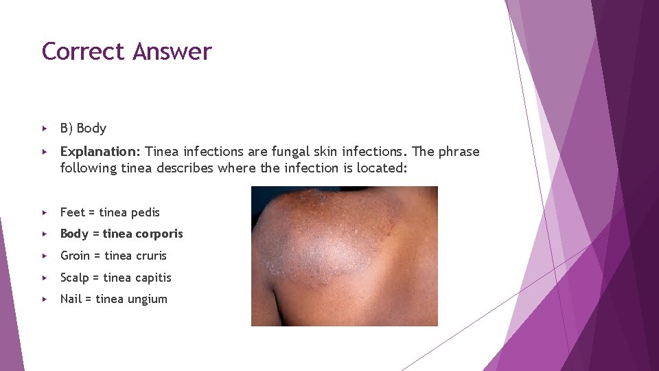 Correct Answer ▶ B) Body ▶ Explanation: Tinea infections are fungal skin infections. The Correct Answer ▶ B) Body ▶ Explanation: Tinea infections are fungal skin infections. The