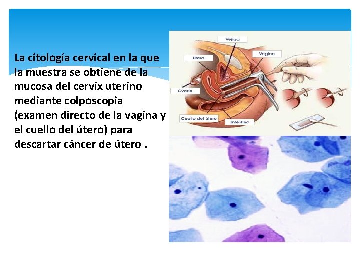 La citología cervical en la que la muestra se obtiene de la mucosa del