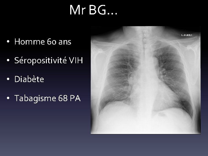 Mr BG… • Homme 60 ans • Séropositivité VIH • Diabète • Tabagisme 68