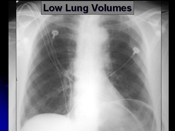 Low Lung Volumes 