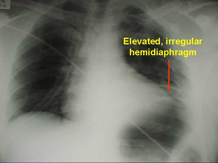 Elevated, irregular hemidiaphragm 