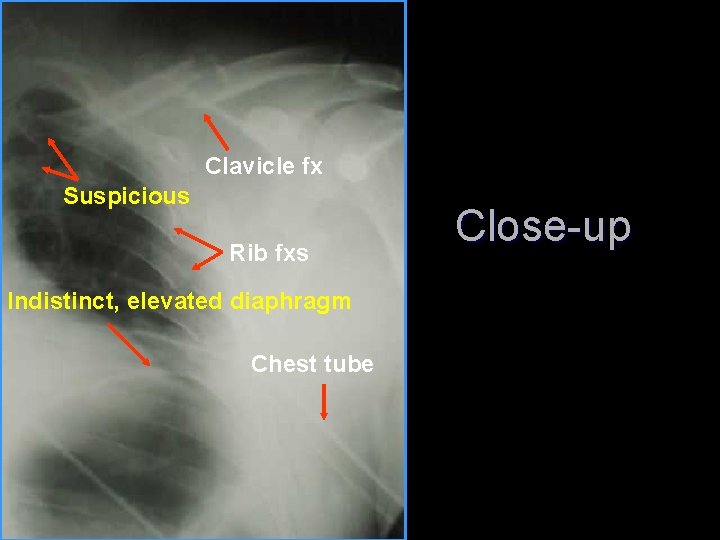 Clavicle fx Suspicious Rib fxs Indistinct, elevated diaphragm Chest tube Close-up 