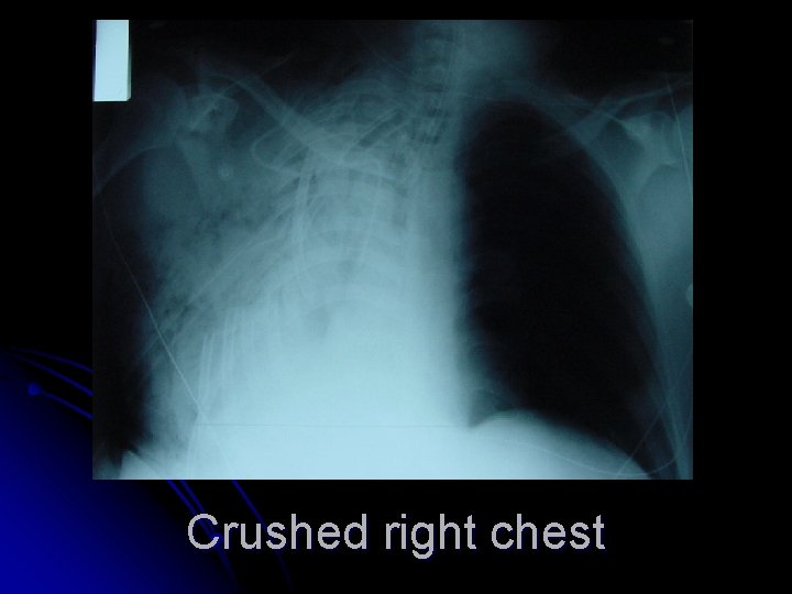 Crushed right chest 