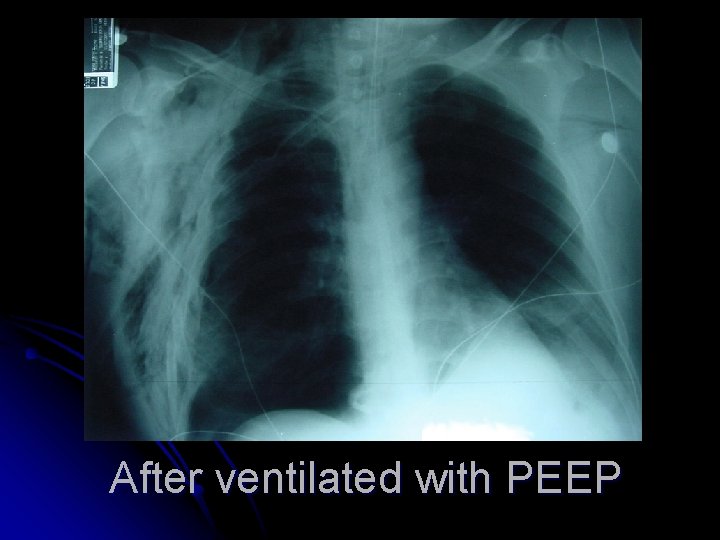 After ventilated with PEEP 