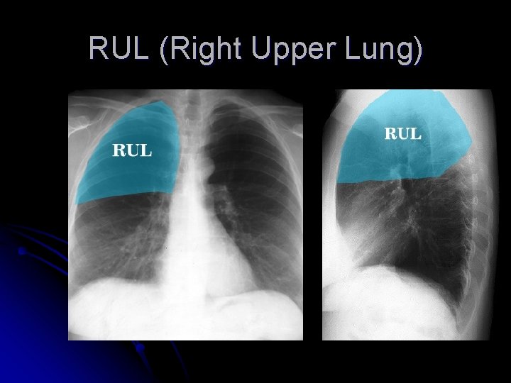 RUL (Right Upper Lung) 