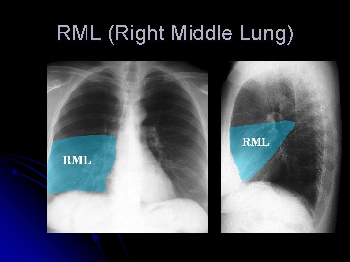 RML (Right Middle Lung) 