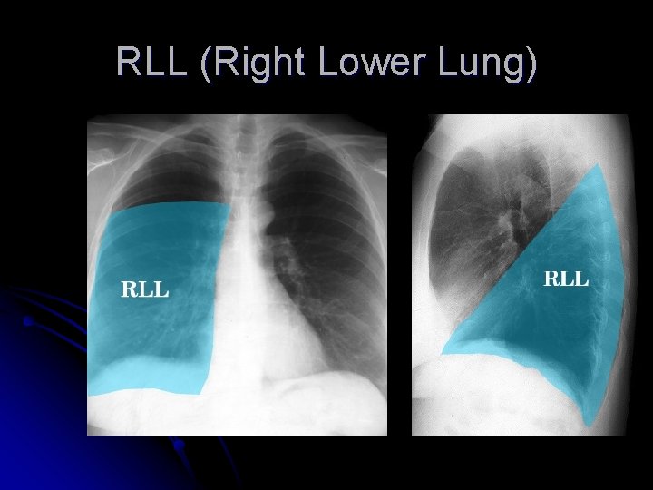 RLL (Right Lower Lung) 