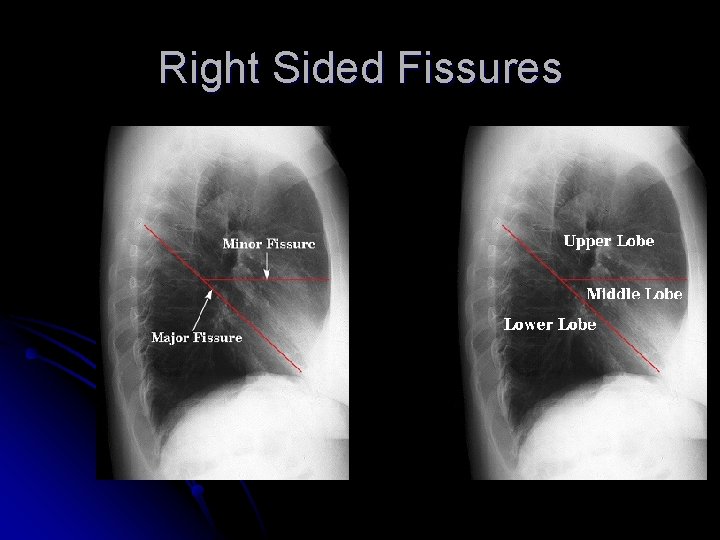 Right Sided Fissures 