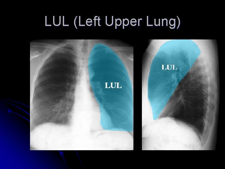 LUL (Left Upper Lung) 