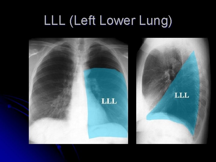 LLL (Left Lower Lung) 