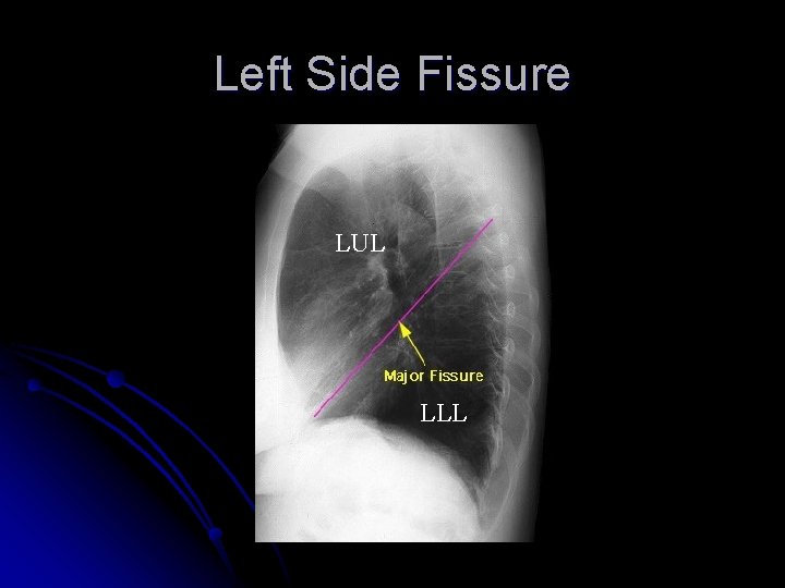 Left Side Fissure LUL LLL 