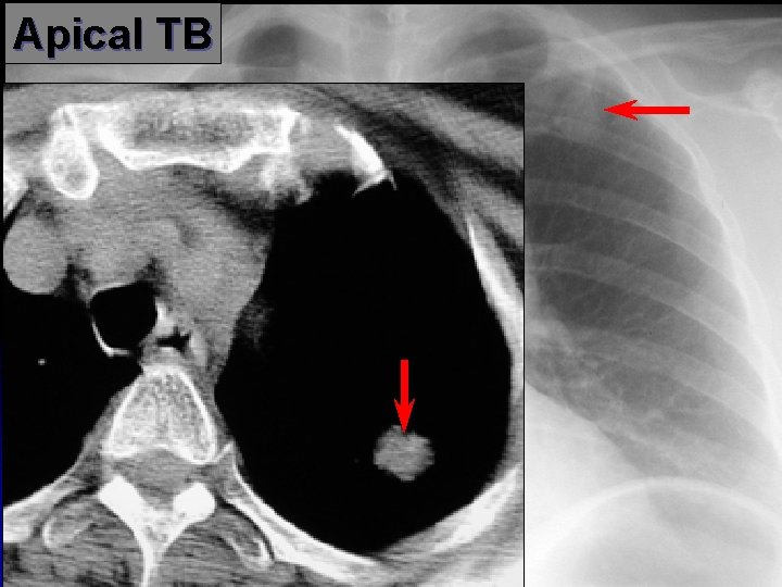 Apical TB 