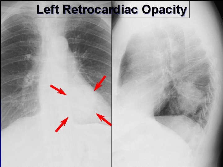 Left Retrocardiac Opacity 