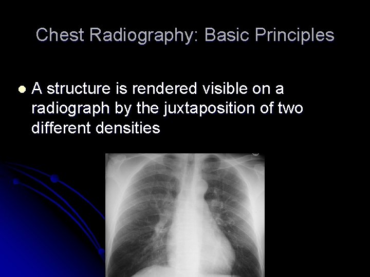 Chest Radiography: Basic Principles l A structure is rendered visible on a radiograph by