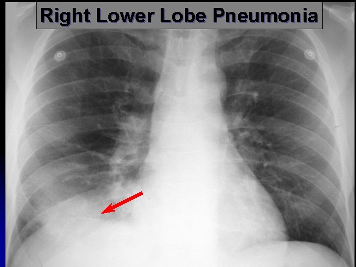 Right Lower Lobe Pneumonia 