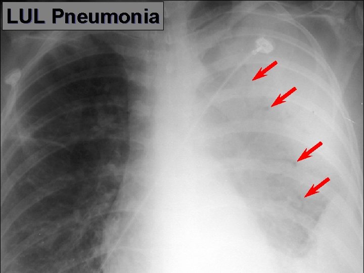 LUL Pneumonia 