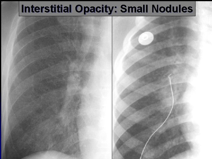 Interstitial Opacity: Small Nodules 