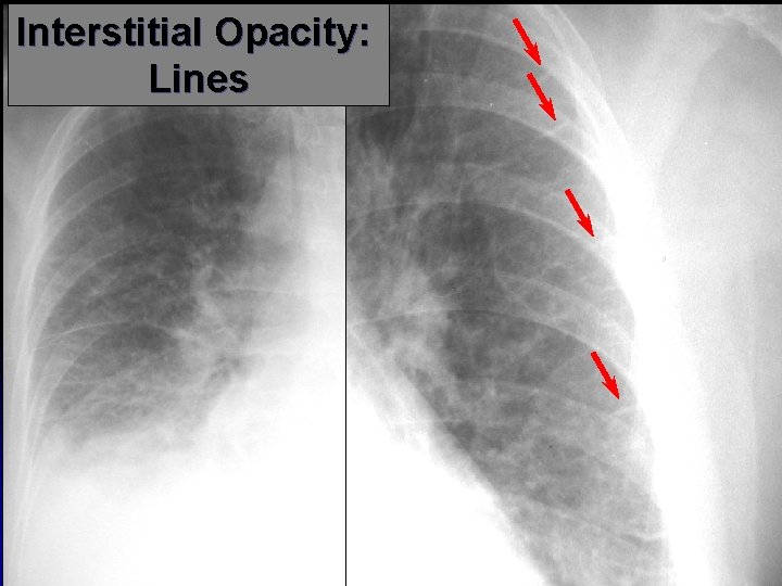 Interstitial Opacity: Lines 