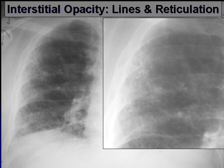 Interstitial Opacity: Lines & Reticulation 