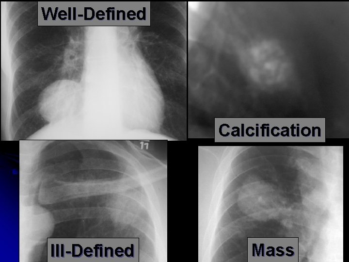 Well-Defined Calcification Ill-Defined Mass 