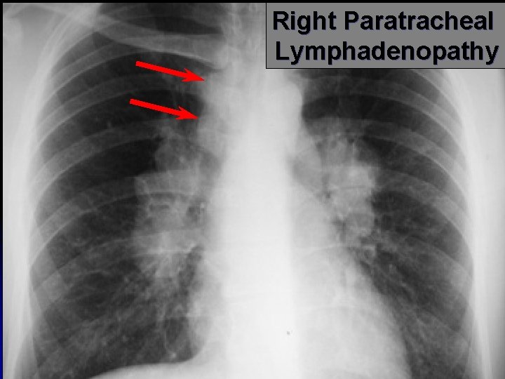 Right Paratracheal Lymphadenopathy 