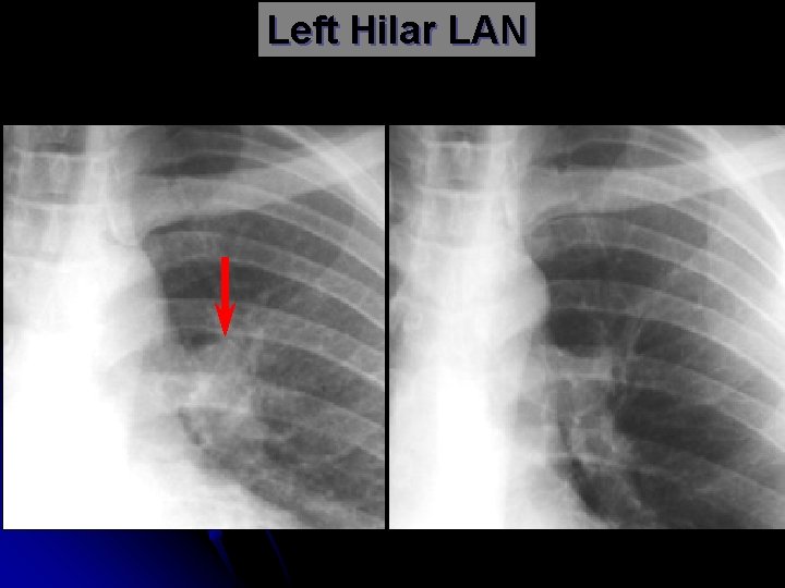 Left Hilar LAN 
