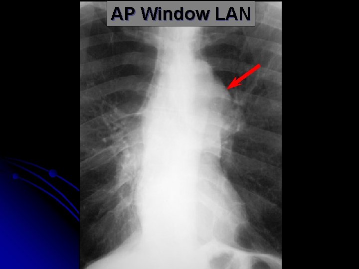 AP Window LAN 