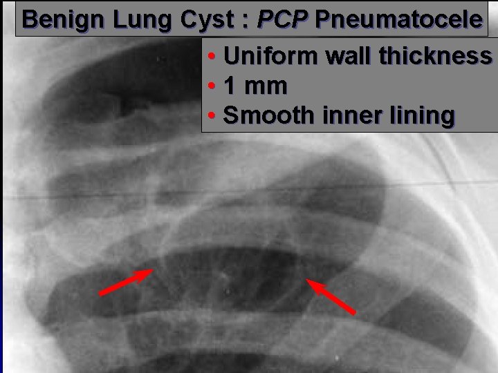 Benign Lung Cyst : PCP Pneumatocele • Uniform wall thickness • 1 mm •