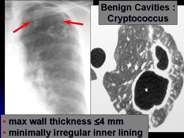 Benign Cavities : Cryptococcus • max wall thickness 4 mm • minimally irregular inner