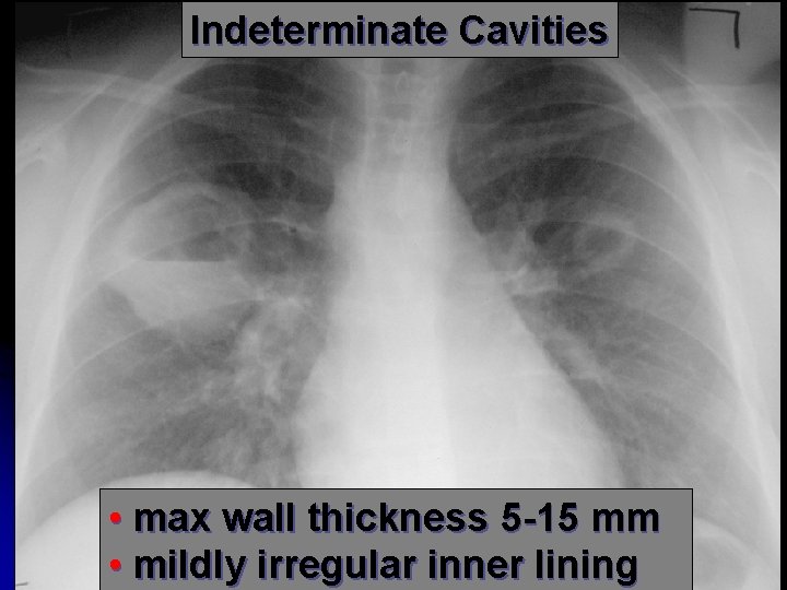 Indeterminate Cavities • max wall thickness 5 -15 mm • mildly irregular inner lining