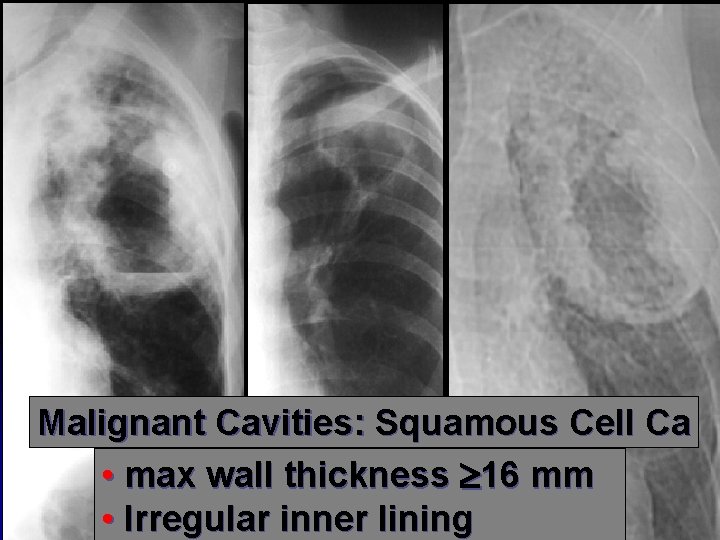 Malignant Cavities: Squamous Cell Ca • max wall thickness 16 mm • Irregular inner