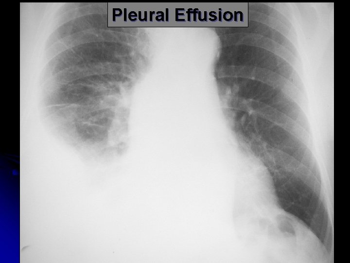 Pleural Effusion 