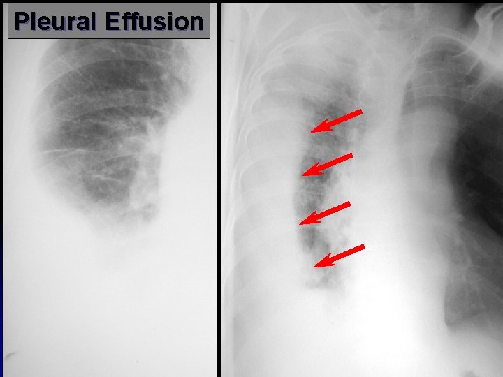 Pleural Effusion 