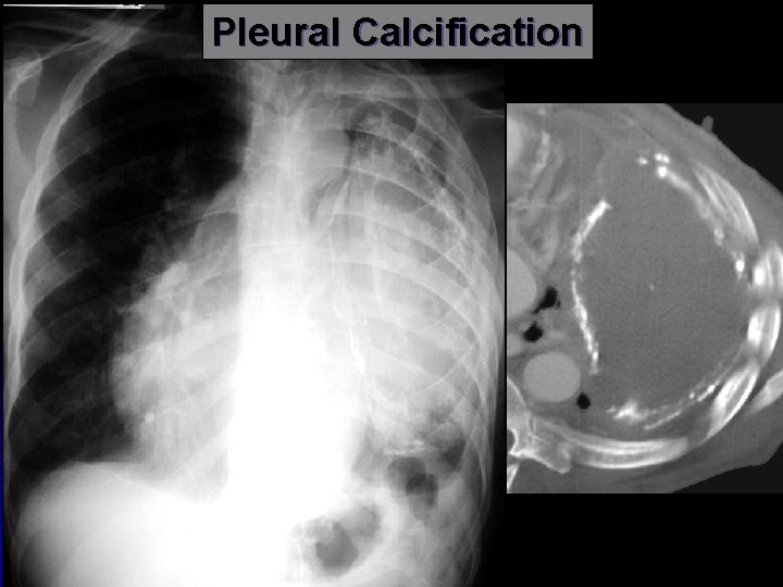 Pleural Calcification 