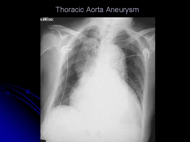 Thoracic Aorta Aneurysm 