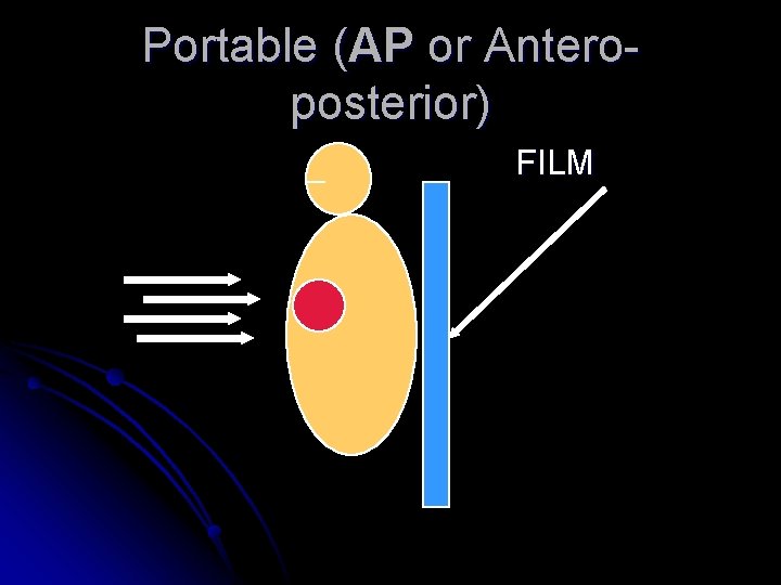 Portable (AP or Anteroposterior) FILM 