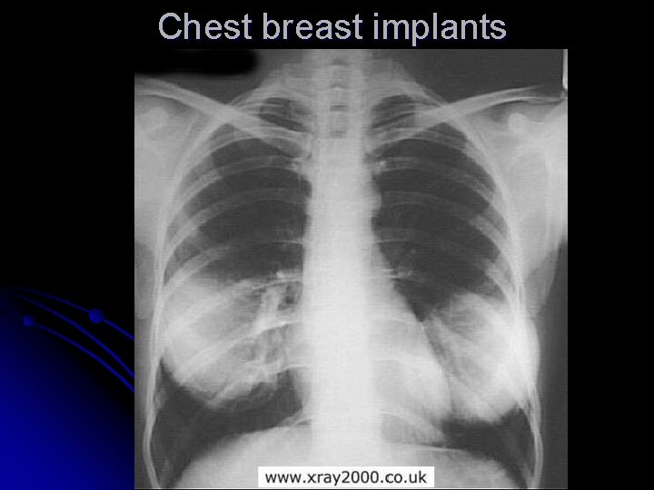 Chest breast implants 
