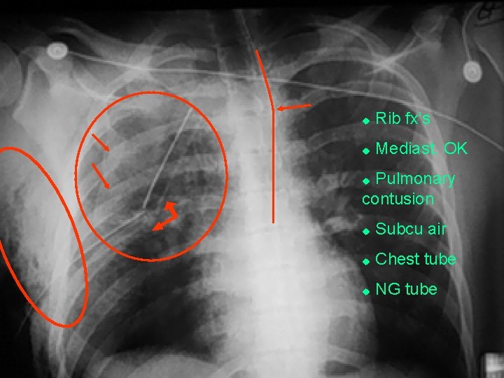u Rib fx’s u Mediast. OK Pulmonary contusion u u Subcu air u Chest
