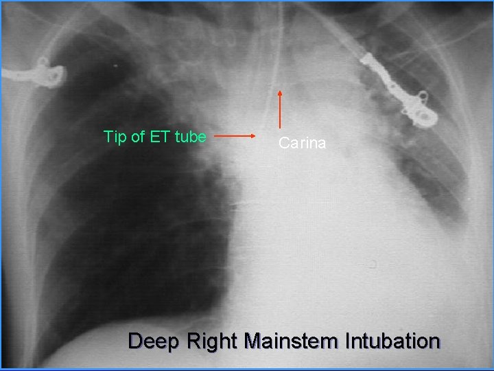Tip of ET tube Carina Deep Right Mainstem Intubation 