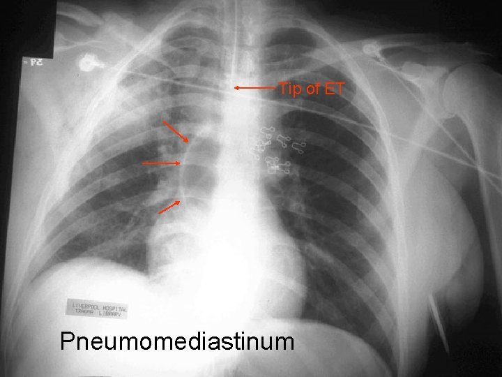 Tip of ET Pneumomediastinum 