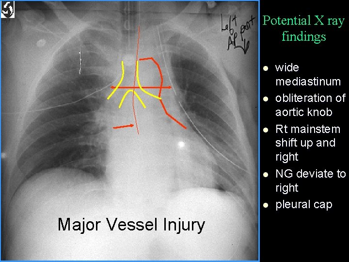 Potential X ray findings l l l Major Vessel Injury wide mediastinum obliteration of