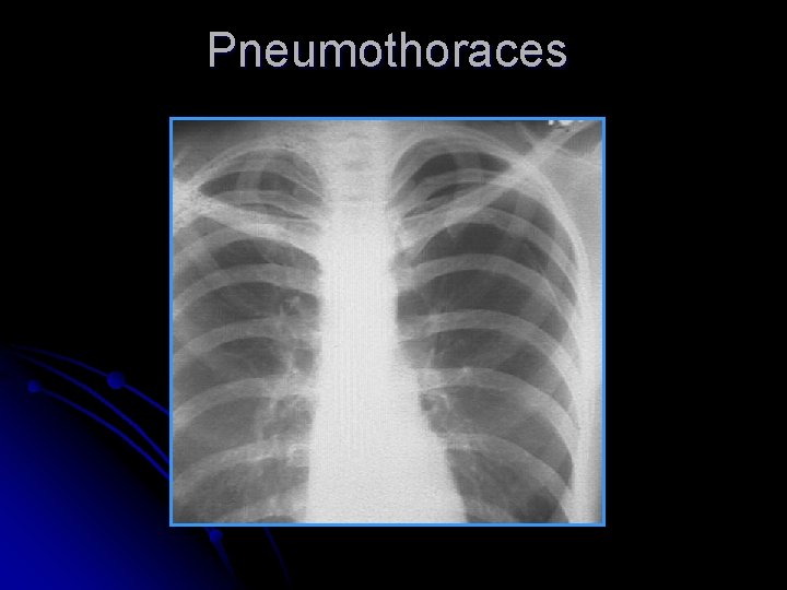 Pneumothoraces 