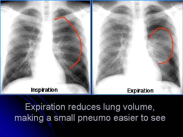 Expiration reduces lung volume, making a small pneumo easier to see 