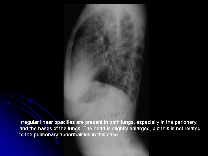 Irregular linear opacities are present in both lungs, especially in the periphery and the