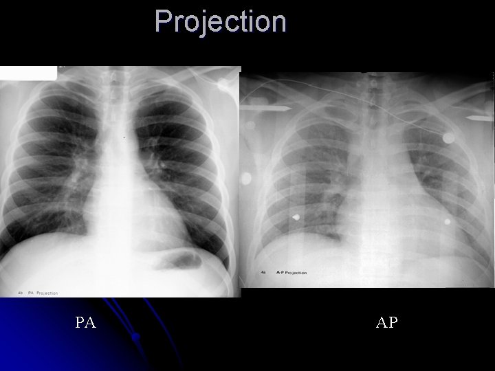 Projection PA AP 