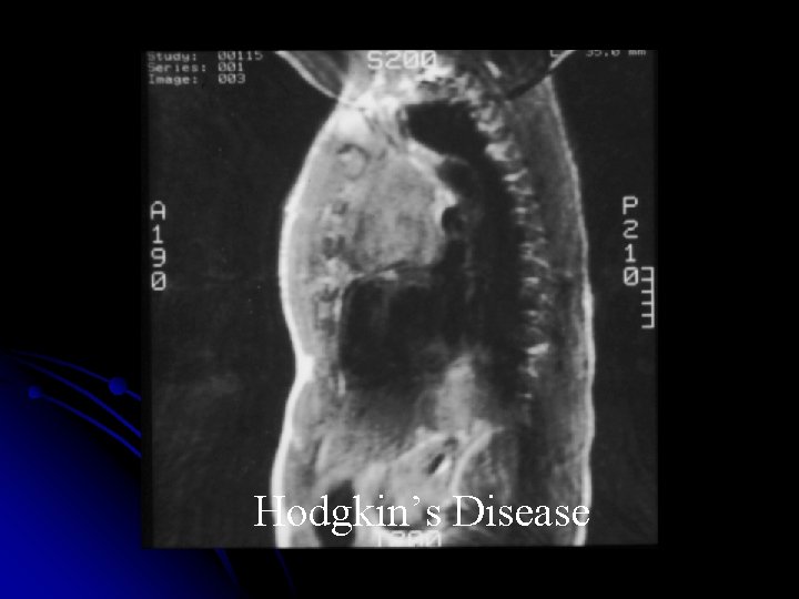 Hodgkin’s Disease 