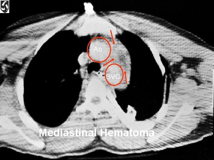 Ao SVC Mediastinal Hematoma 